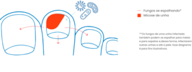 micose unha